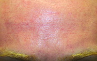 acne scar treatment - after